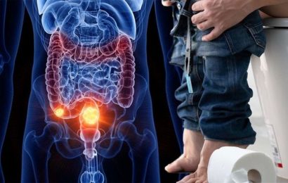 Bowel cancer symptoms: The number of times you poo in a day could signal the disease