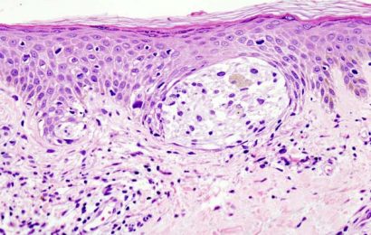 Relatlimab plus nivolumab improves progression-free survival in metastatic melanoma