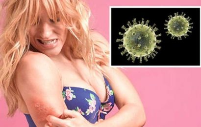 Shingles signs: Four ‘early symptoms’ on your skin – ‘usually affects a specific area’