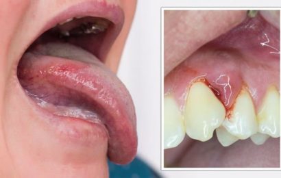 Vitamin B12 deficiency: The sore sign in your mouth you should never ignore