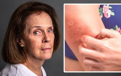 Shingles: One thing you must not do to treat the viral infection – ‘this slows healing’