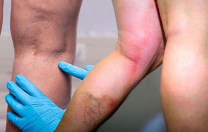Blood clot: How do I know if I have a blood clot in my leg? Five key symptoms be aware of