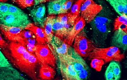 Scientists target protein to lower risk of prostate cancer spread