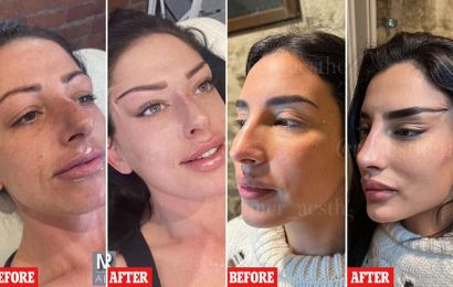 Why are young women risking permanent damage with &apos;fox-eye facelifts&apos;?