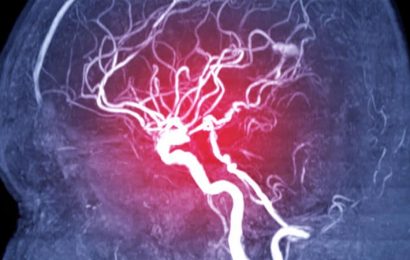 A Genetic Risk Factor for Intracranial Aneurysm Rupture