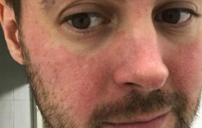 Man with ‘irritated, red skin’ for 10 years finds office air freshener to blame