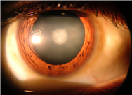 Drug treatment for cataracts moves a step closer
