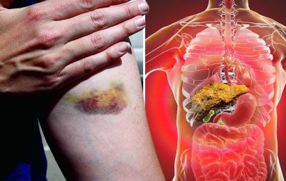 Fatty liver disease: Do you bruise easily? The warning sign of ‘severe’ liver damage