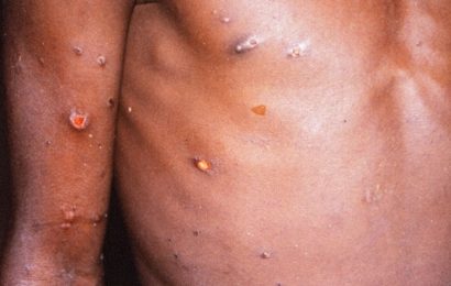 Monkeypox symptoms and crusty rash to be aware of as cases rise in the UK