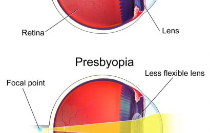 New eye drops can help aging people see better: An optometrist explains how Vuity treats presbyopia