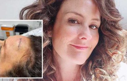 ‘My childhood sunburn gave me skin cancer in my 40s’ – the first sign