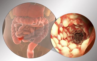 Crohns Disease Biomarker Appears Years Ahead of Diagnosis