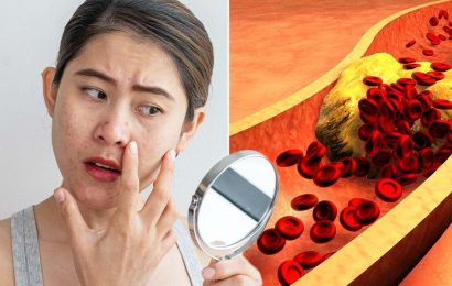 High cholesterol symptoms: The ‘irreversible’ sign on your face – shows up ‘within hours’