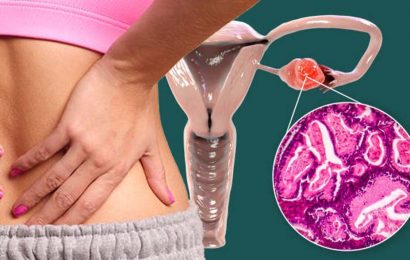 Ovarian cancer symptoms: The subtle sign in your back indicating ‘cancer cells’