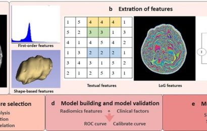 Radiomic model helps predict radiotherapy treatment response in patients with brain metastases