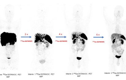 Targeted radionuclide treatment achieves high response rate, minimal toxicities for advanced-stage neuroendocrine tumors