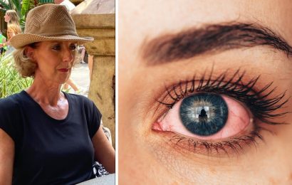 53-year-old suffered for 12-years with ‘sore, cracked eyes’ – condition explained
