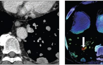 AI vs. clinical reports: Incidental pulmonary embolism on chest CT