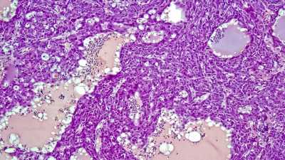 Liver Cancer Risk Persists After DAA Treatment for HCV