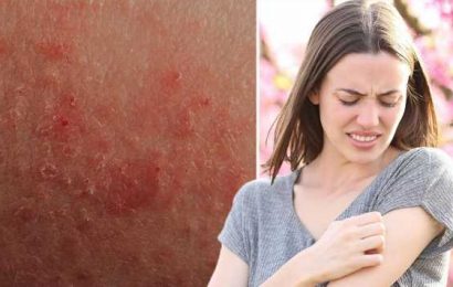 The ‘little known’ rash caused by sunlight that affects one in five – signs