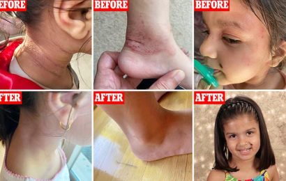 Girl, 5, saw eczema clear up ten days after getting new treatment