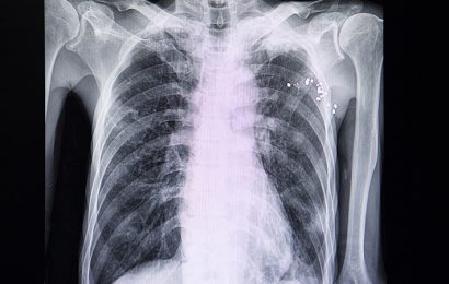 Lung Volume Reduction Methods Show Similar Results for Emphysema