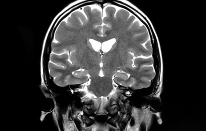 MRI shows brain microstructural changes after mild COVID-19