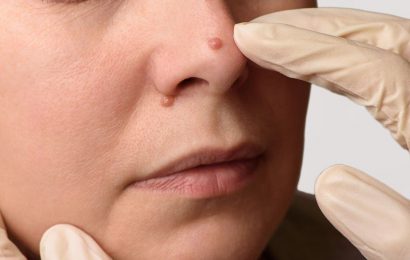 Subtle changes in your face could be hinting at hypothyroidism