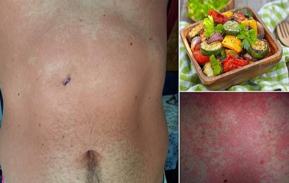 World&apos;s first person who is ACTUALLY allergic to vegetables