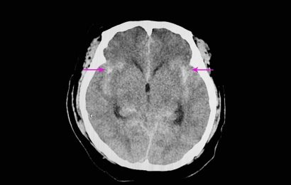 Combo Thrombolytic Approach Fails to Reduce ICH in Stroke