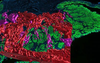 Researchers are building detailed maps of colorectal cancer to better understand the dynamics of the disease