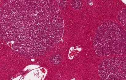 Liver cancer research: Iron-dependent cell death could be key to novel combination therapies