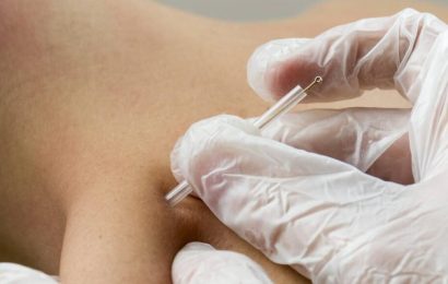 On pins and needles: Just what is dry needling?
