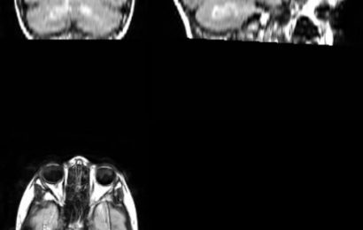 Automated tool can link brain scans to cognitive deficits in people with neurofibromatosis type 1