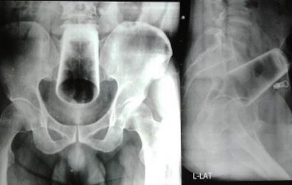 Married man, 47, got glass stuck in his bum for 3 days while drunk