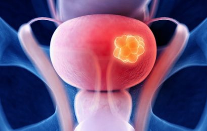Trial Casts Shadow on Photodynamic Surgery for Bladder Cancer
