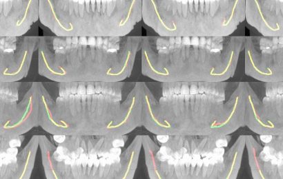 Artificial intelligence assists in dental care and jaw surgery