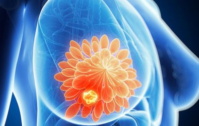 Breast Cancer Recurrence Rates Much Higher in Black, Asian Women