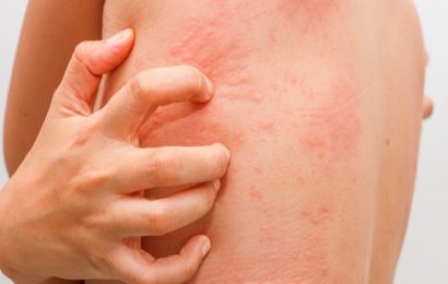 Stress rash: What is it and how to treat it