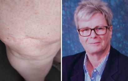 Woman told mole on arm benign after check-up – doctors discovered something else
