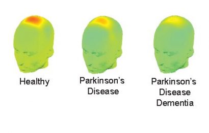 Brain waves may predict cognitive impairment in Parkinsons disease