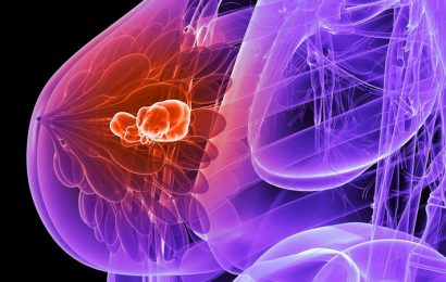 Ribociclib Forestalls Recurrence Also in Early Breast Cancer