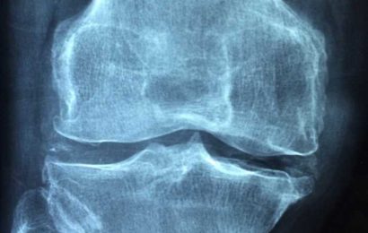 Designing surfaces to improve bone grafts