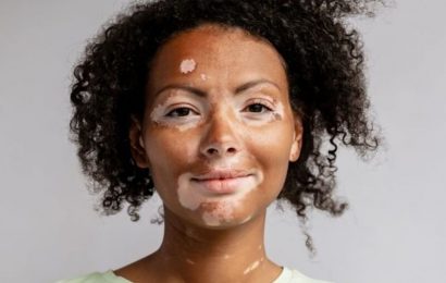 Incidence rate of diagnosed vitiligo 22.6 per 100,000 person-years