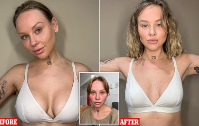My breast implants made me go blind