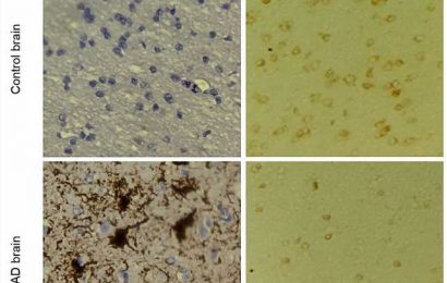 Tau-regulating protein identified as a promising target for developing Alzheimers disease treatment