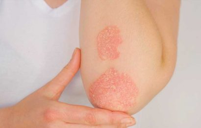 Is there an association between psoriasis onset and risk of autoimmune disease?