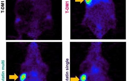 PET imaging validates use of common cholesterol drug to enhance HER2-targeted cancer therapy