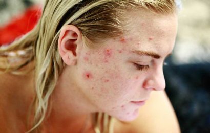 Uncovering the emotional scars: Study reveals significant stigma associated with female adult acne