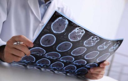 AI-based MRI tools show promise in multiple sclerosis diagnosis